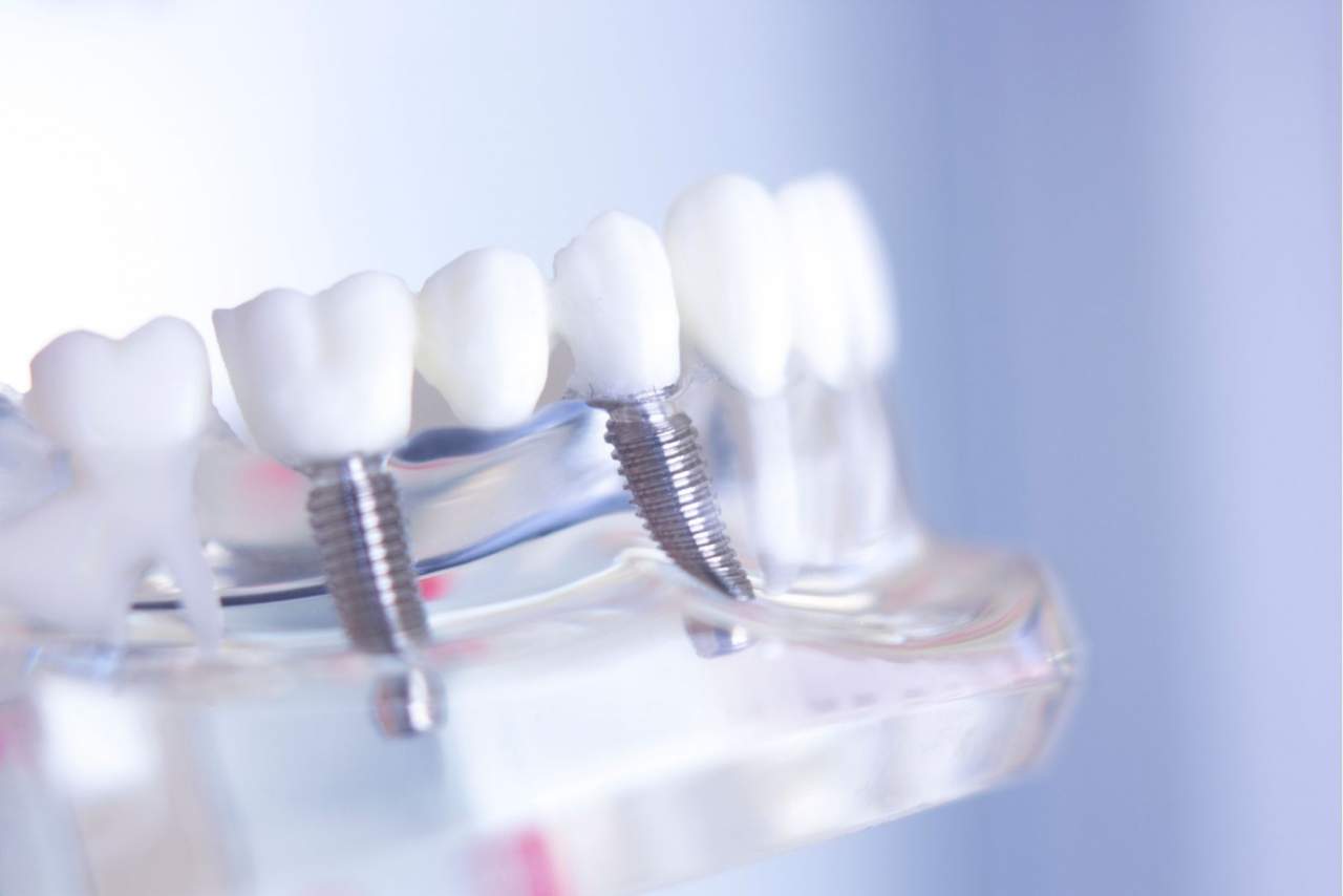 Sonríe una vez más, y cómete el mundo: Implante dental Sevilla