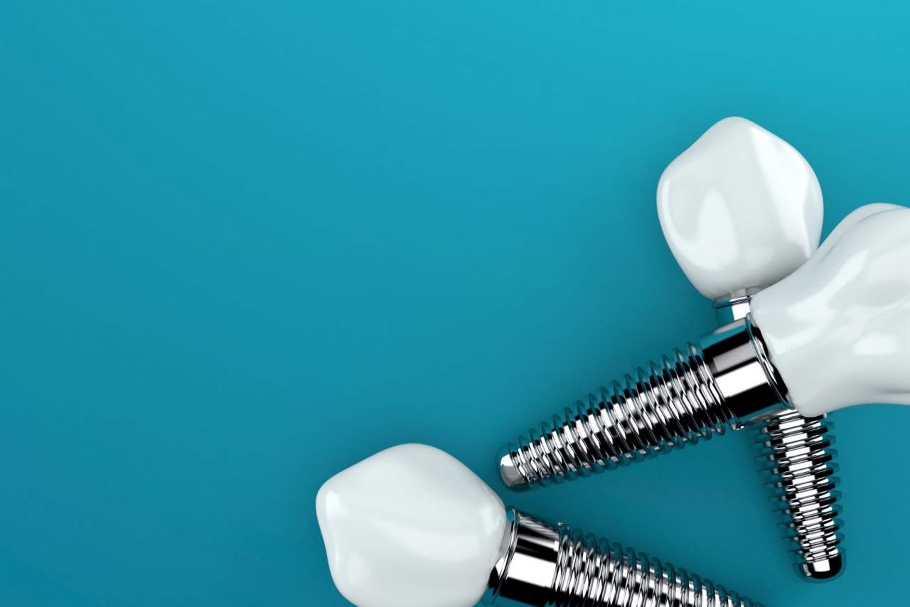 Implante dental profesional en Sevilla de Helident