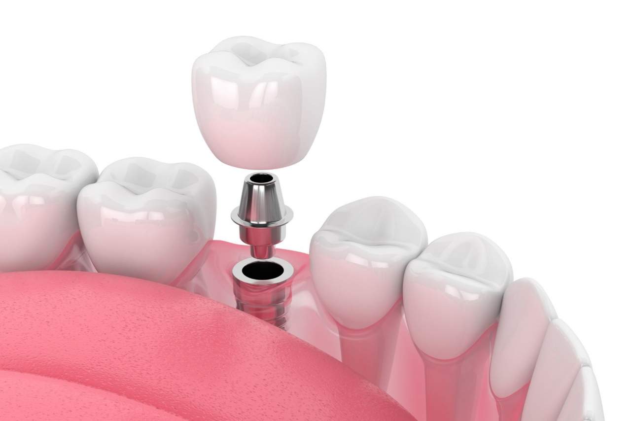 Helident Training Center: ¿Los implantes duran para siempre?¿Qué cuidados necesitan? Por Helident Training Center