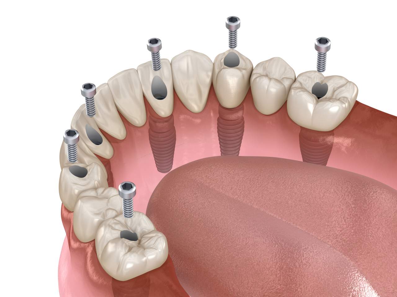 Clínica Helident Sevilla recomienda el uso de la mejor calidad en implantes
