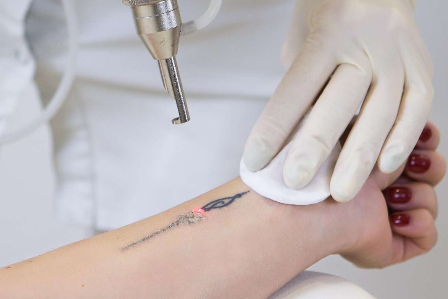 El centro Bodyslim dispone de Yag Láser para eliminar tatuajes