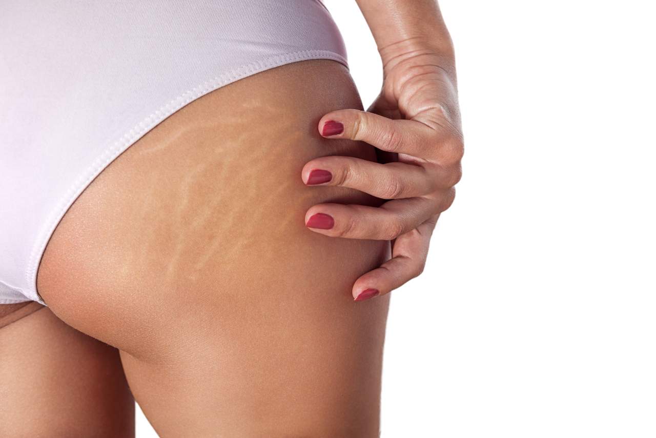 ¿Cómo quitar las estrías? por Clínica Estética Alicante