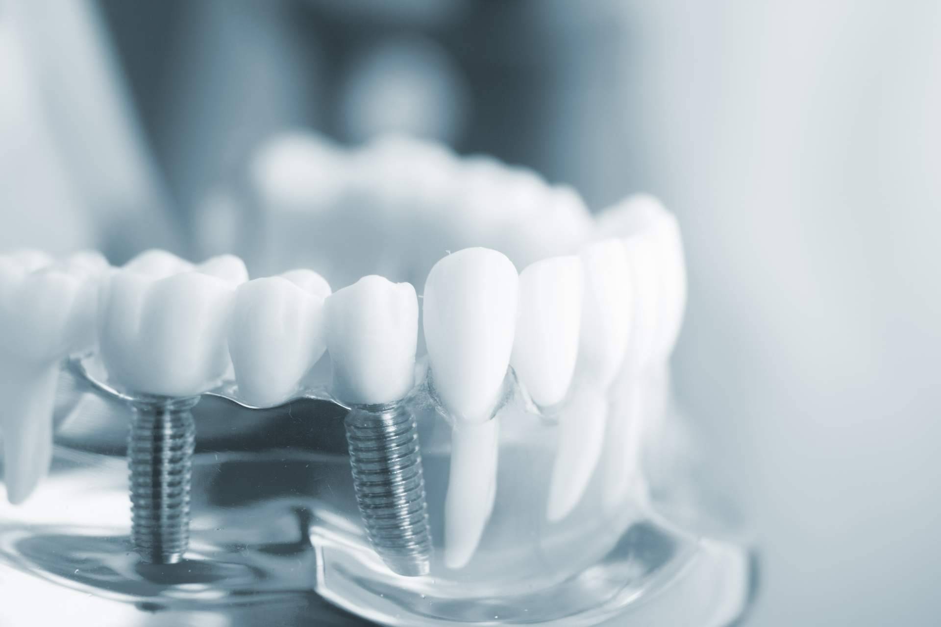 La Clínica Artydents en Madrid logra conseguir dientes fijos en un solo día gracias a los implantes dentales de titanio V