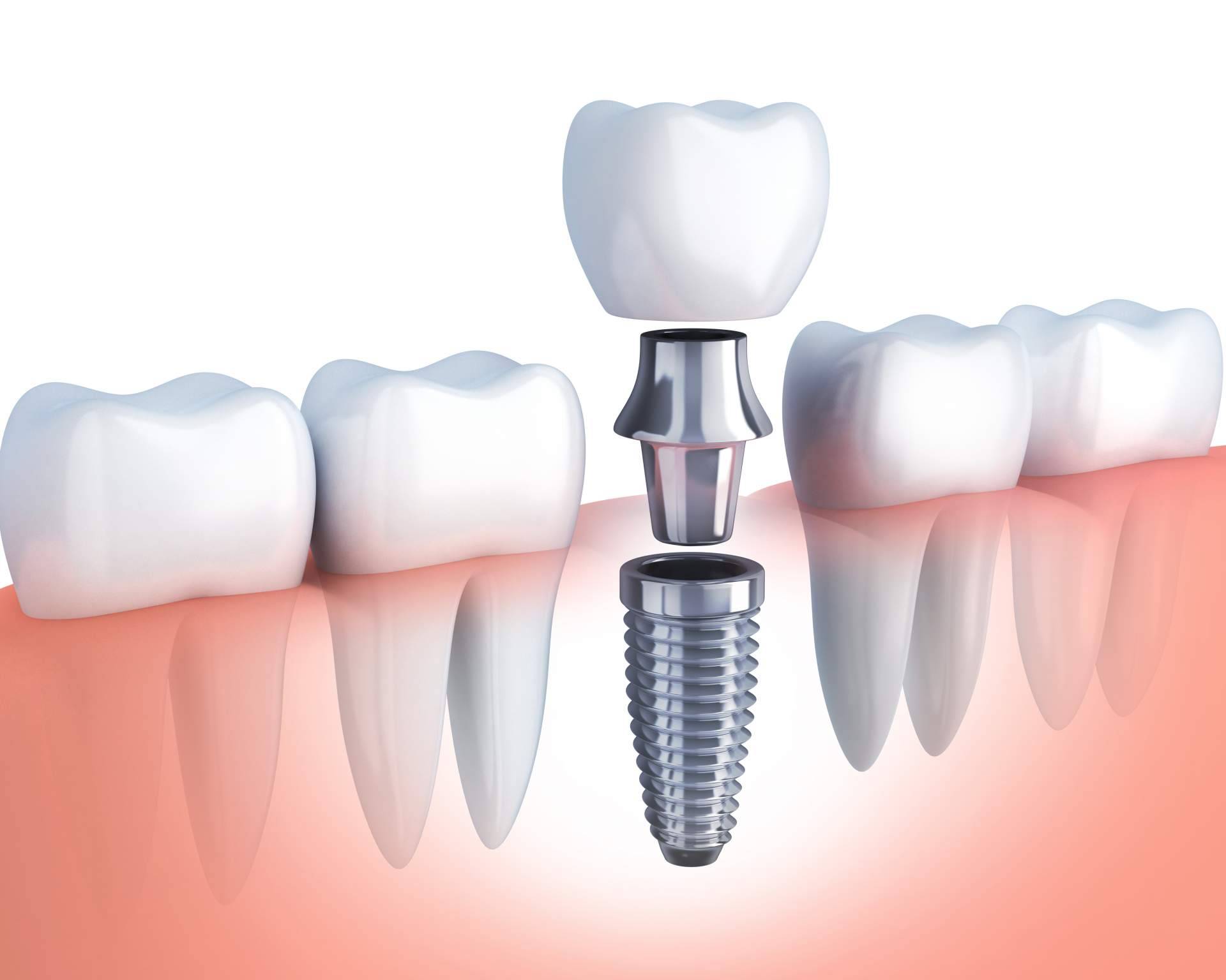 ¿Por qué es tan exitoso el implante dental de titanio V de la Clínica Artydents en Madrid?