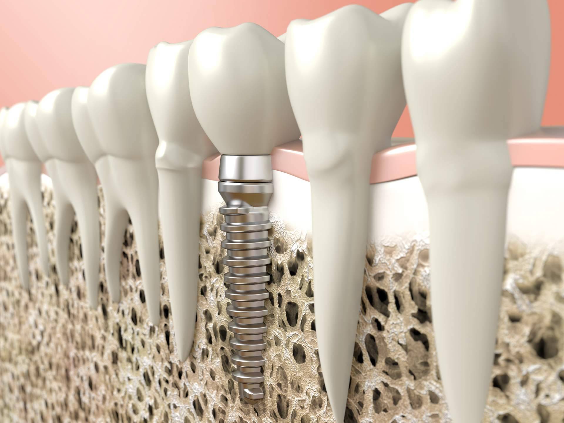 Clínica Dental Heins: tratamiento de implantes dentales y ortodoncia invisible