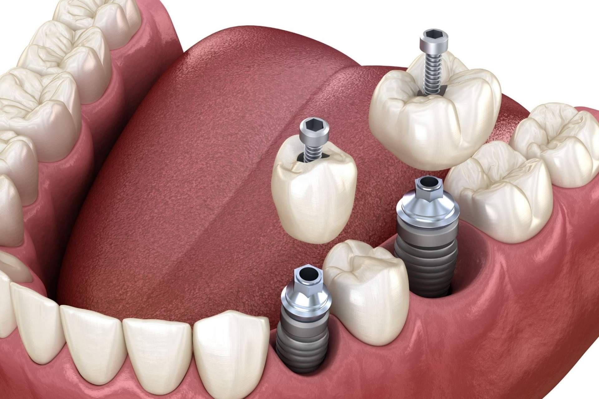 Los implantes de carga inmediata que ofrece Implant Clinics