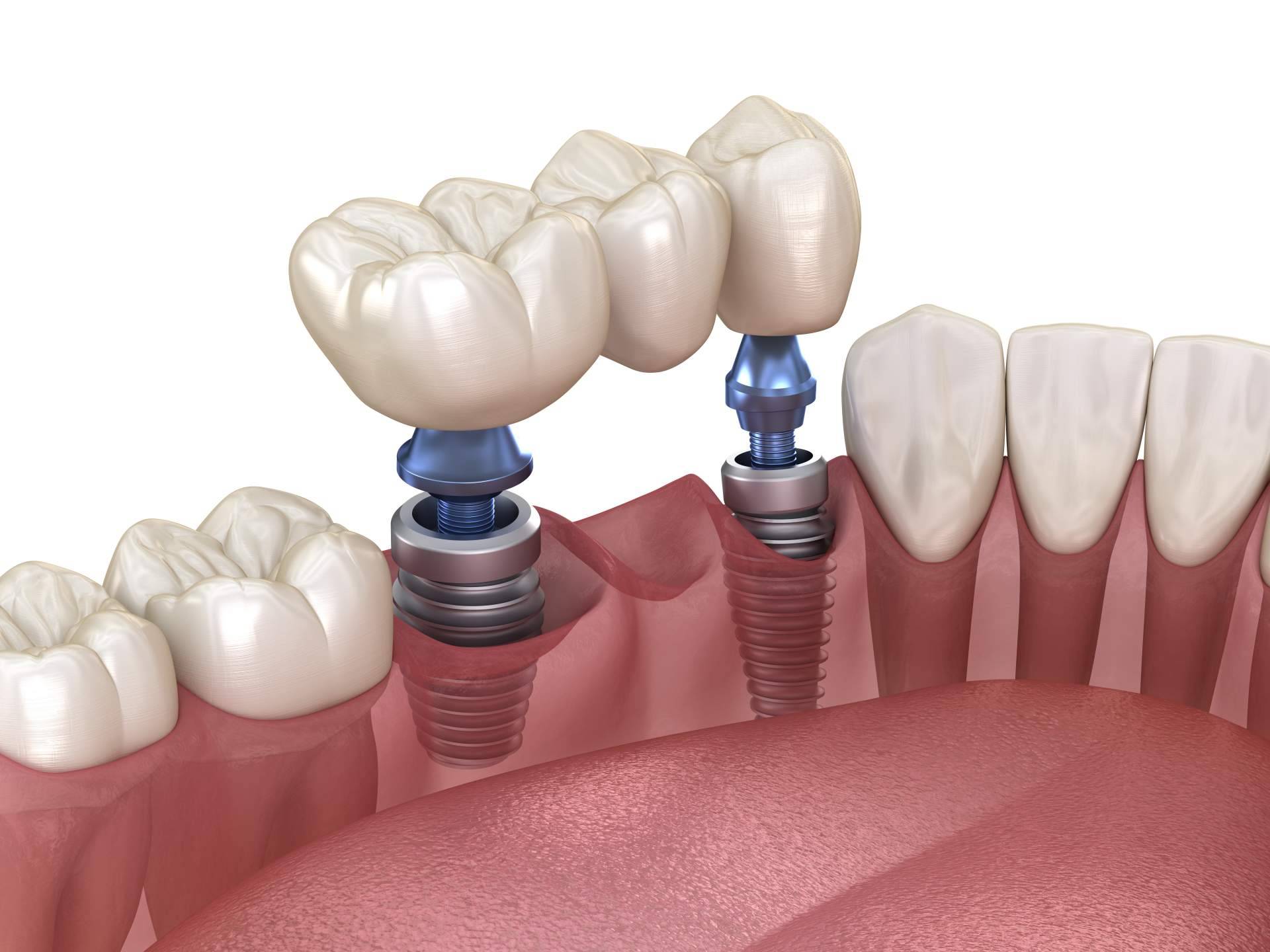 El procedimiento de implante dental de titanio en Sevilla que realiza Clínica Dental Helident