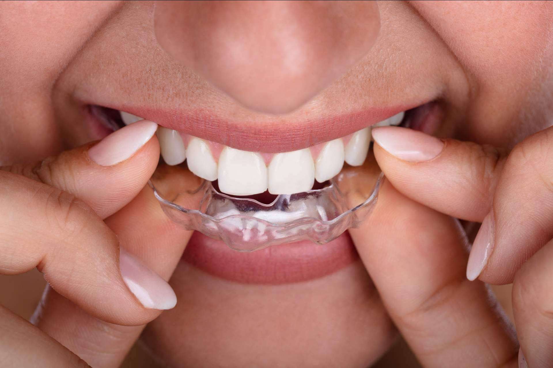 Las ventajas de elegir Smile Aligner como ortodoncia invisible