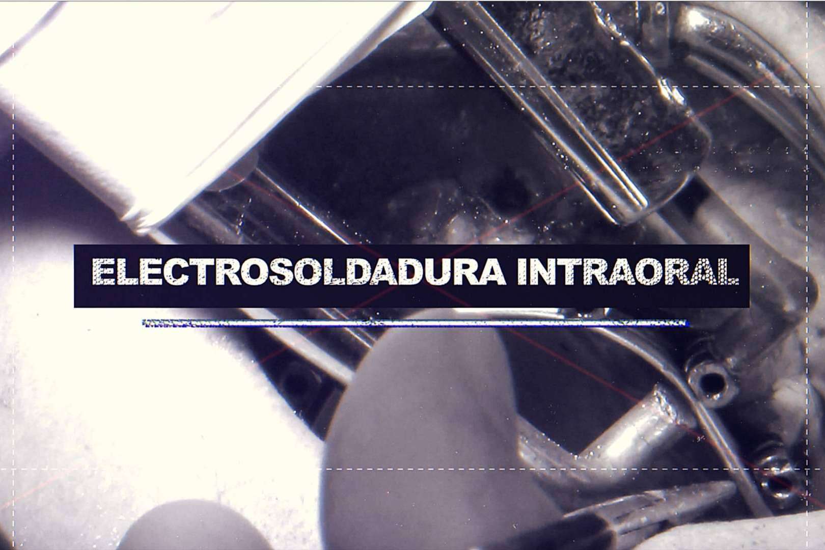 La técnica del Dr. Ismael Soriano que ofrece múltiples ventajas a los pacientes, los implantes con dientes inmediatos