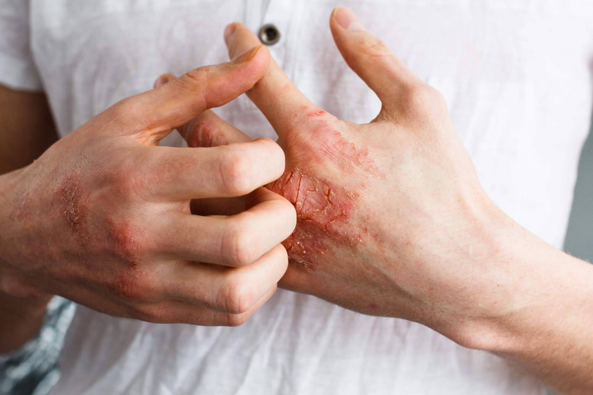 ¿Cómo se diferencia un eczema de contacto de un eczema atópico?, por Laboratorio Géomer