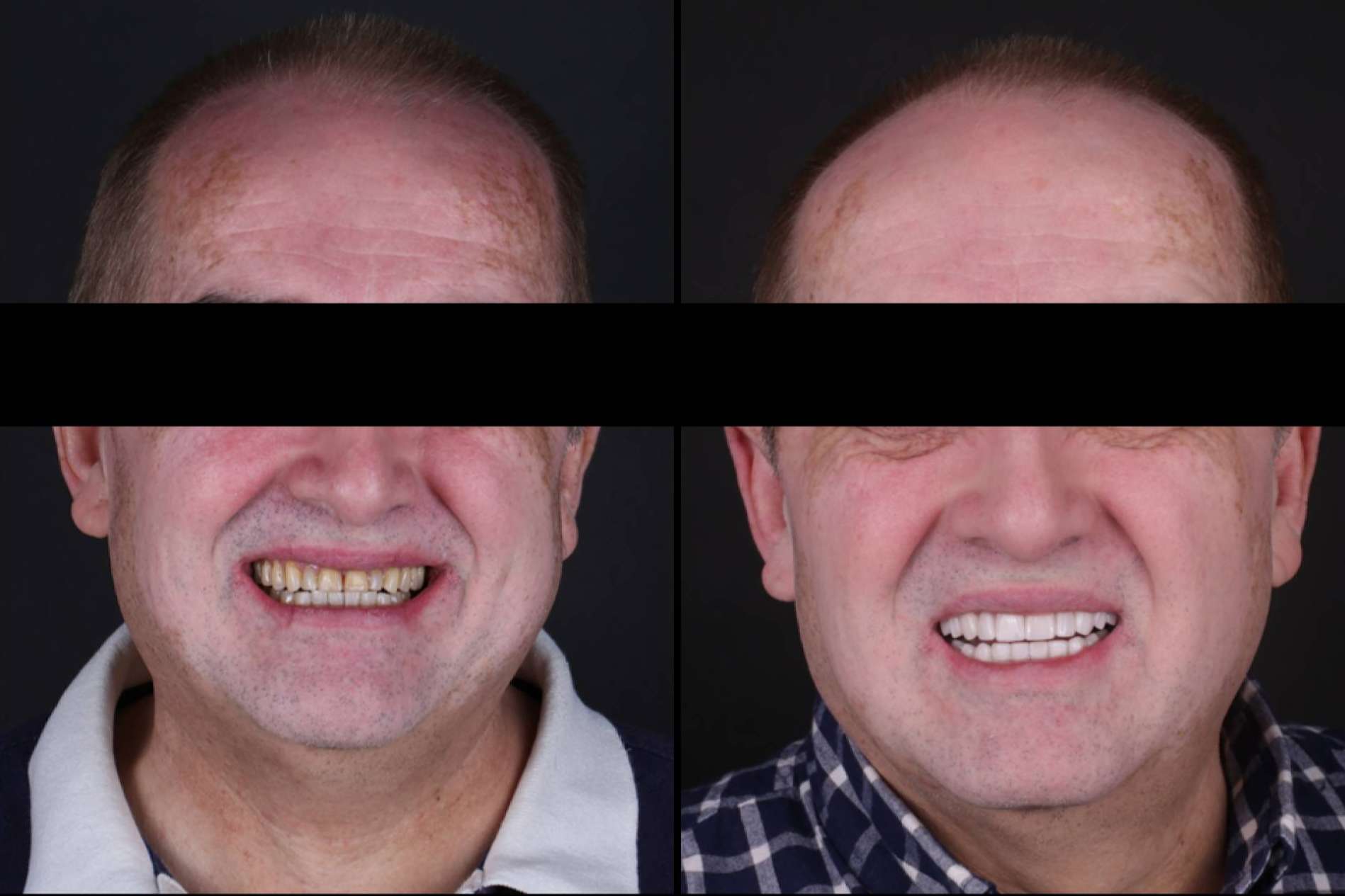 Las múltiples ventajas de las carillas dentales, de la mano de Carillas Wikend®