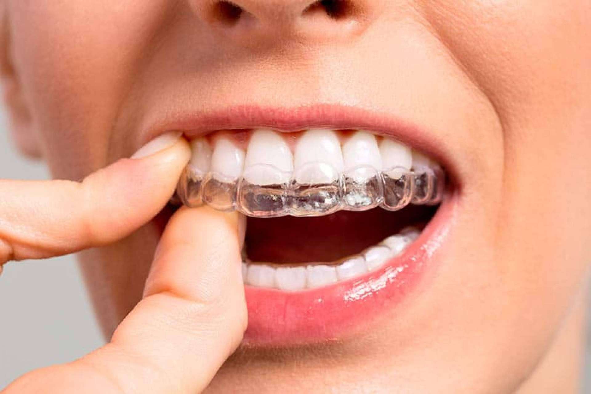 Alineación de dientes con la ortodoncia invisible Invisalign®, en la Clínica Dental Ahoa