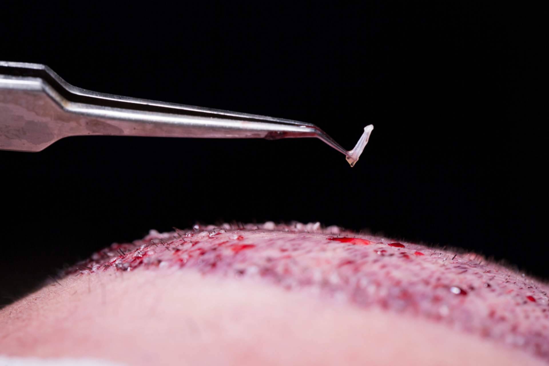 Élite Capilar sobre todos los beneficios del plasma rico en plaquetas