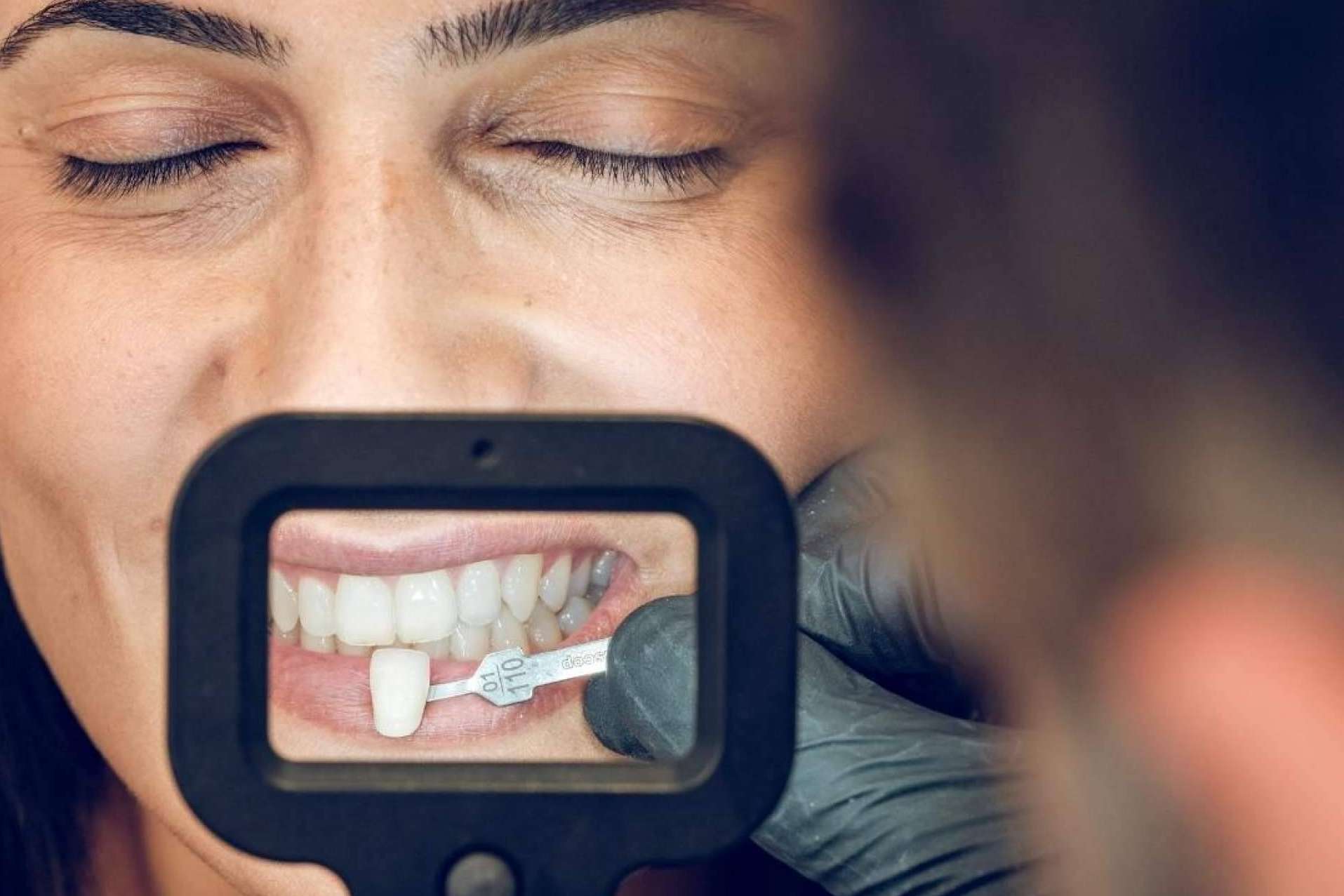Todo lo que se debe saber acerca de las carillas dentales, según Crespí & Gandía