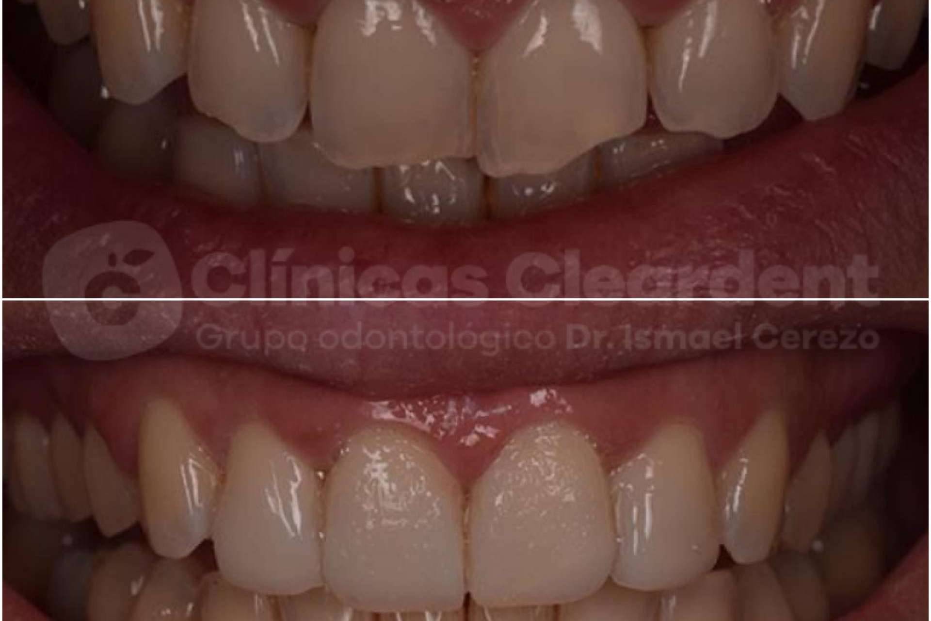 ¿Cuál es la función de las carillas dentales? Las opciones que ofrece Cleardent