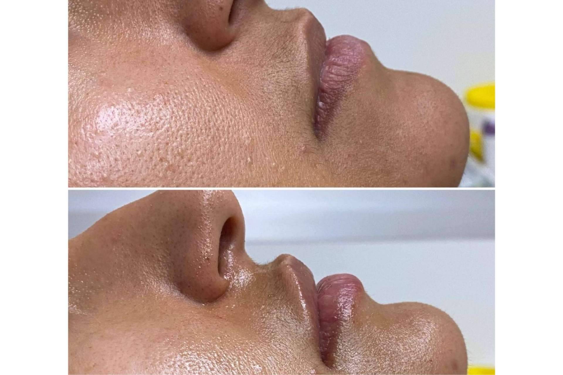 Realizar el tratamiento de aumento de labios en la Clínica Yasmin