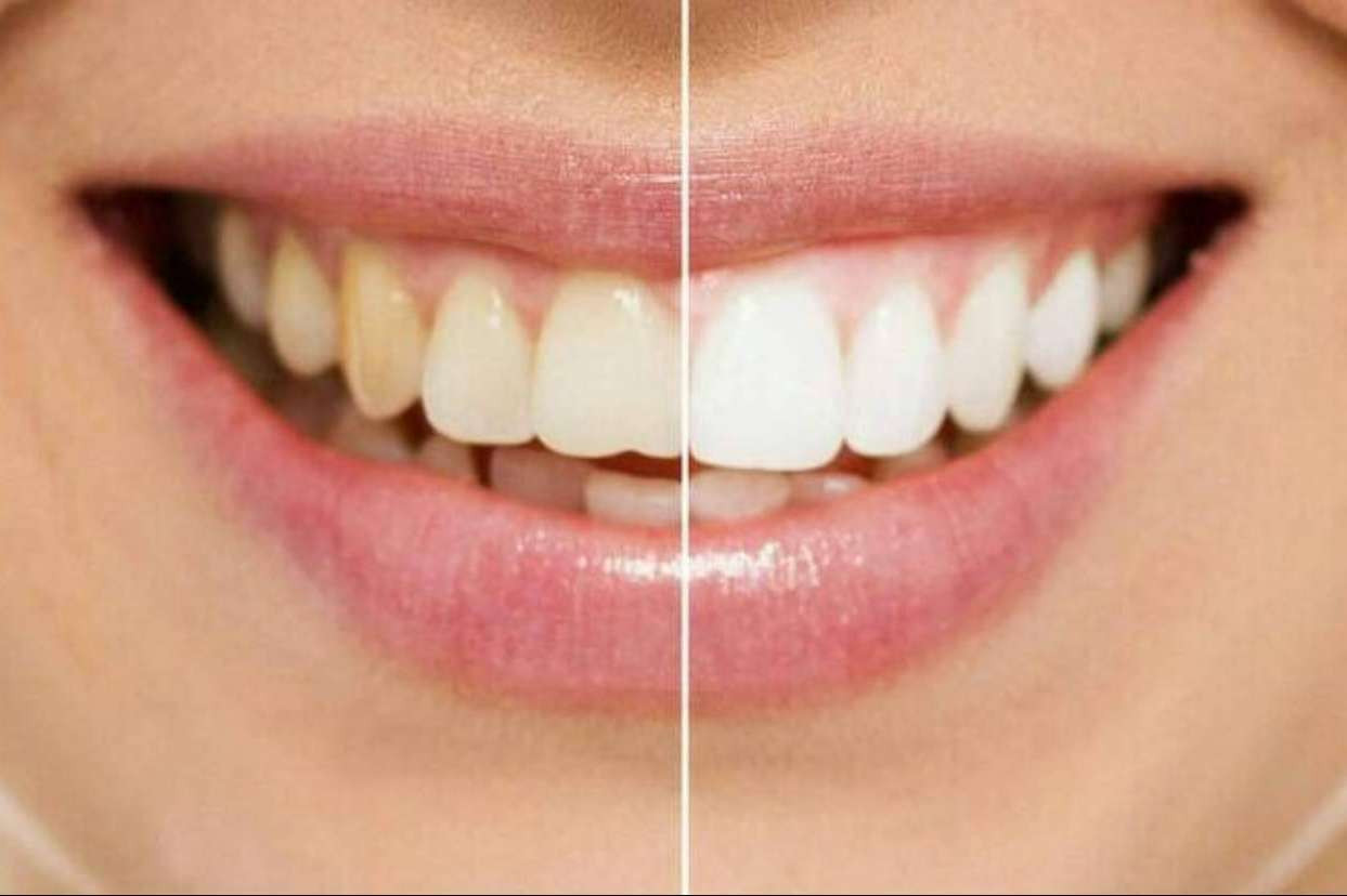 Para conseguir una sonrisa perfecta, ¿Carillas o blanqueamiento?