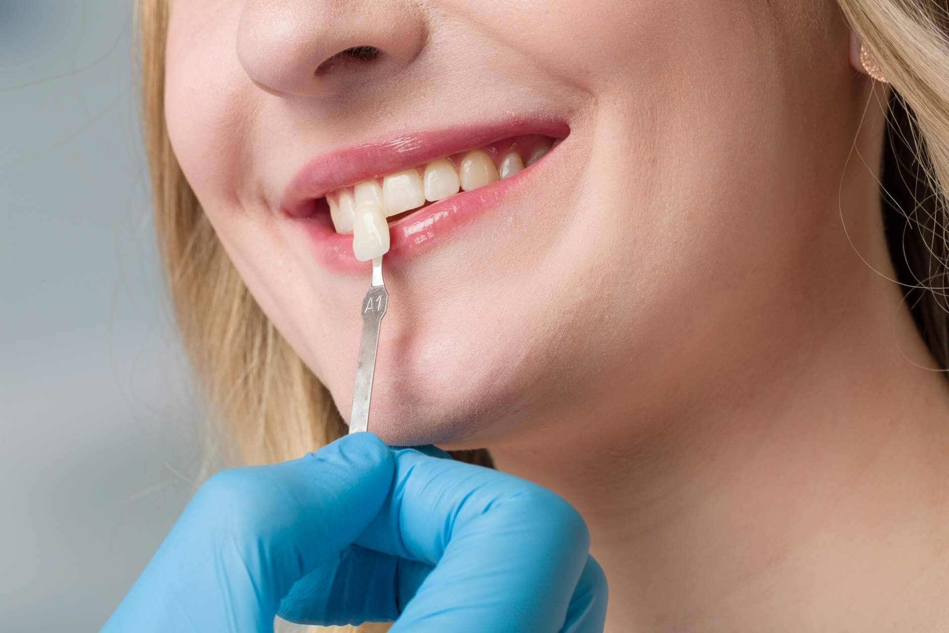 Todo sobre el tratamiento de carillas dentales en esta clínica dental de Chamartín